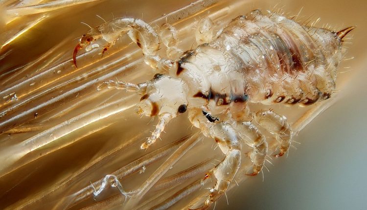 درمان شپش سر