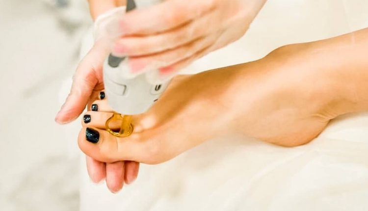 لیزر موی زائد