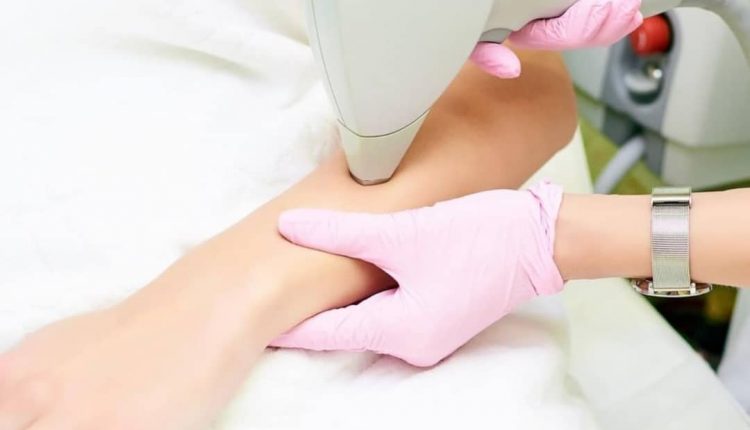 لیزر موی زائد