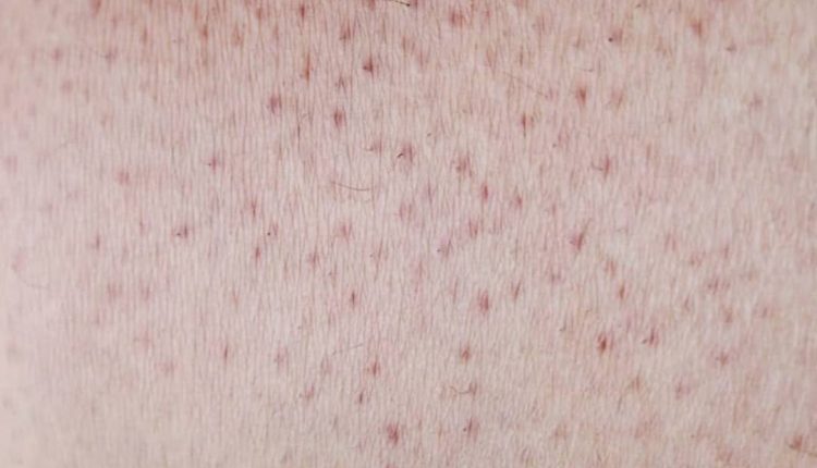 موهای زیر پوستی