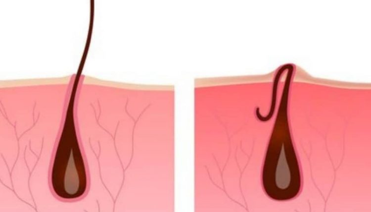 موهای زیر پوستی