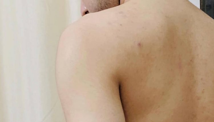 جوش های روی کمر