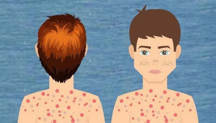 جوش های بدن