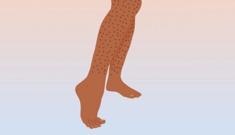 موی زیر پوستی 