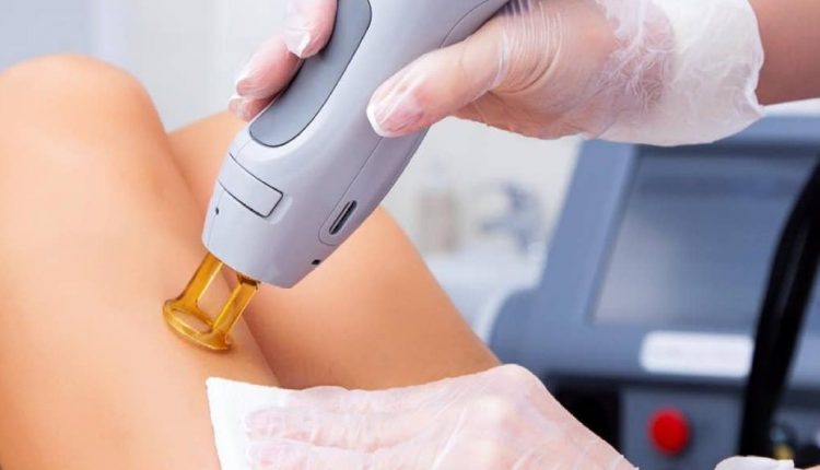 دستگاه های لیزر موهای زائد