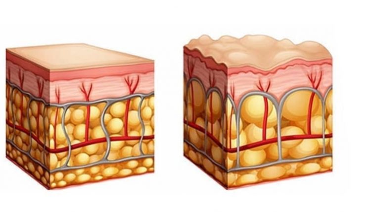 سلولیت چیست؟