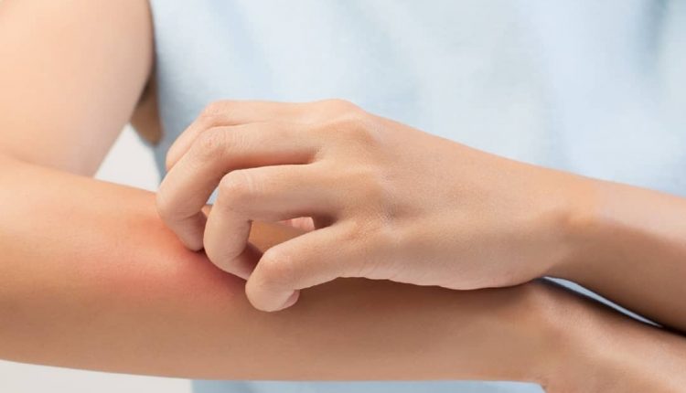 با چند روش درمان سریع خارش بدن در منزل آشنا شوید