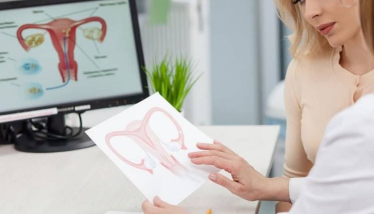 تخمدان پلی کیستیک