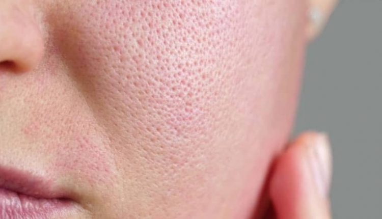 علت پوست پرتقالی شدن صورت