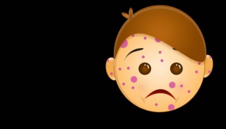 آبله مرغان در کودکان