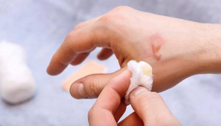 درمان سوختگی پوست